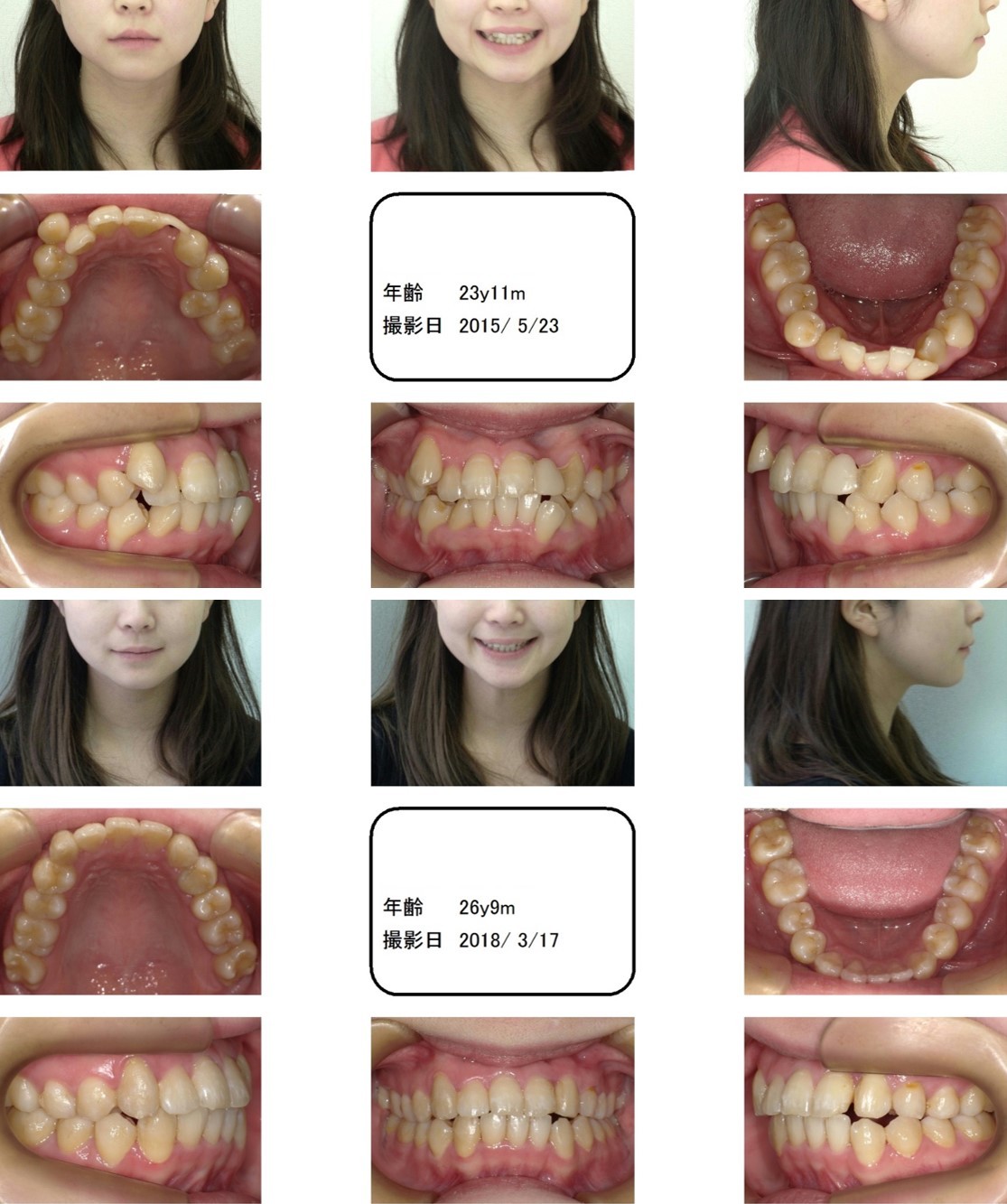 ずっと歯並びがコンプレックスだった２６歳女性 八重歯 叢生の歯並び 三重県伊賀市の矯正認定医がいる歯科