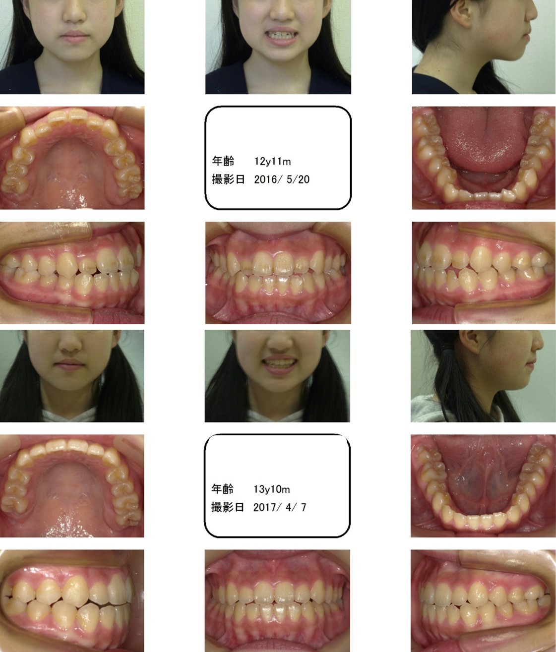 キレイな歯並びになった 13歳 女性 叢生の歯並び 三重県伊賀市の矯正認定医がいる歯科